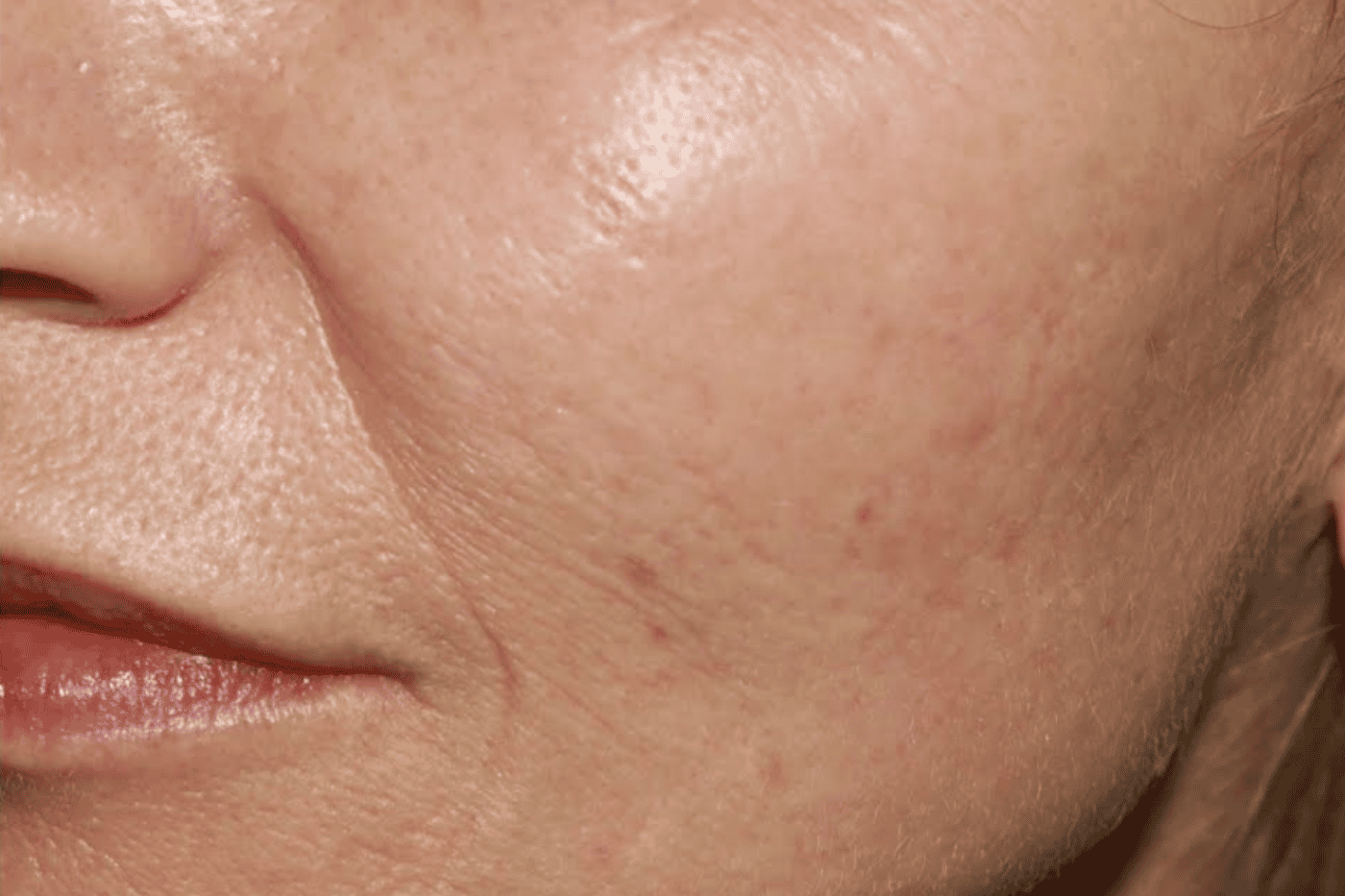 Korean Microneedling after treatment